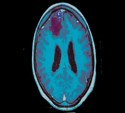 Epilepsia y conducción